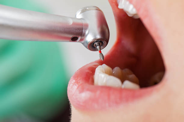 Best Knocked-Out Tooth (Avulsed Tooth) Treatment in Point Mackenzie, AK